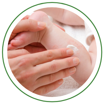 Manos untando crema en bebe